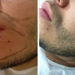 barba tricopigmentacion