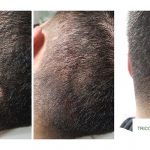 Cicatriz tricopigmentacion