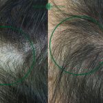 Relleno capilar en mujer