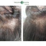 Relleno capilar en mujer