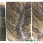 Relleno capilar en mujer