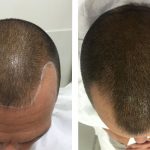 Relleno frontal tricopigmentacion