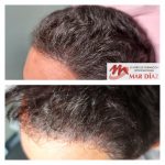 Densidad cabello tricopigmentación